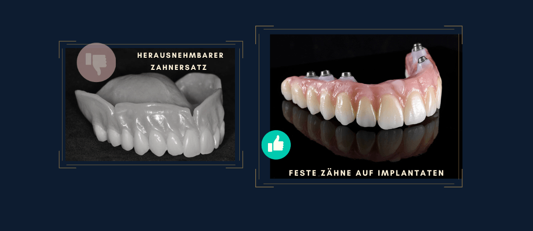 Vergleich: herausnehmbare Prothese vs. feste Zähne auf Implantaten